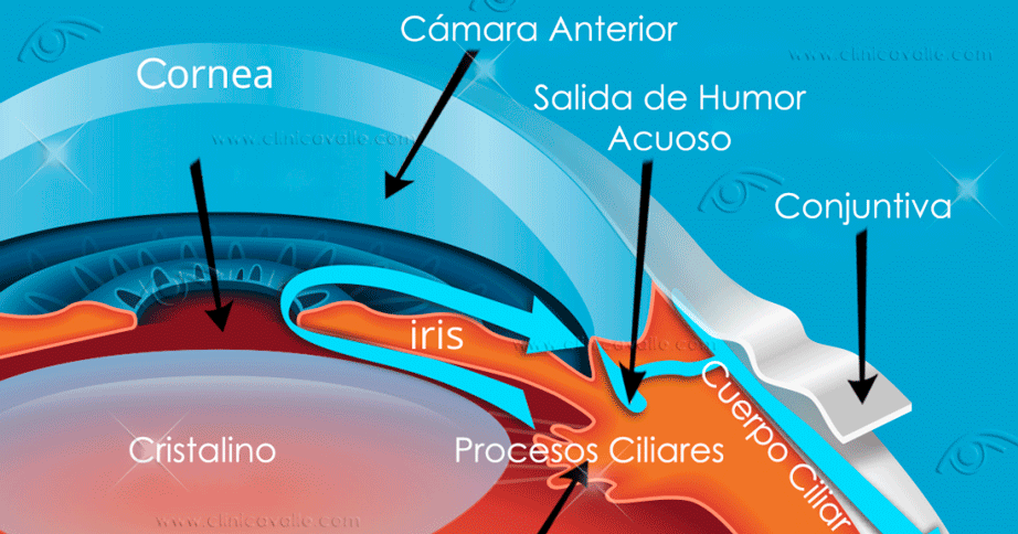 Un Procedimiento Puede Prevenir El Glaucoma En Personas Hiperm tropes 
