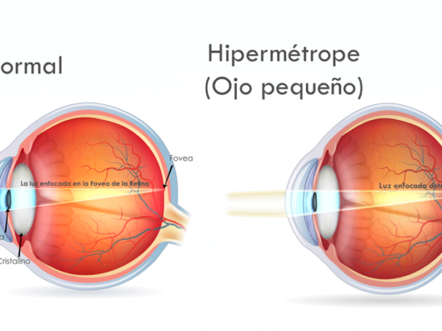 Hipermetropia-1024x546