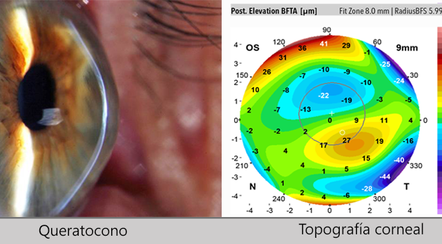 Queratocono-Topografía-corneal-CLÍNICA-VALLE-Oftalmología-y-Especialidades