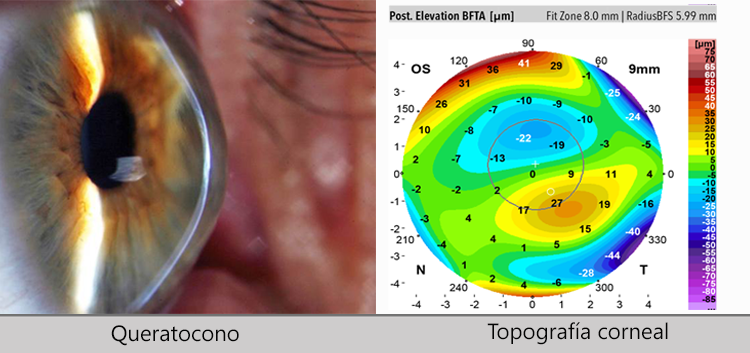 Queratocono-Topografía-corneal-CLÍNICA-VALLE-Oftalmología-y-Especialidades